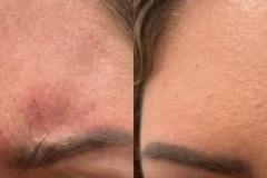 botox2