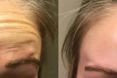 botox4