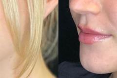fillers2