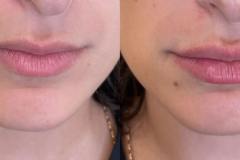 fillers3