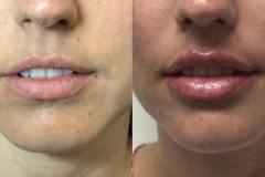 fillers5