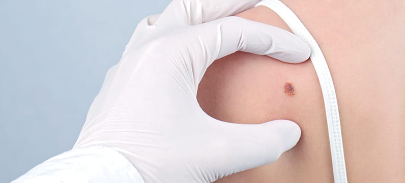 dermatologist examining a sun spot on the back of a patient's shoulder