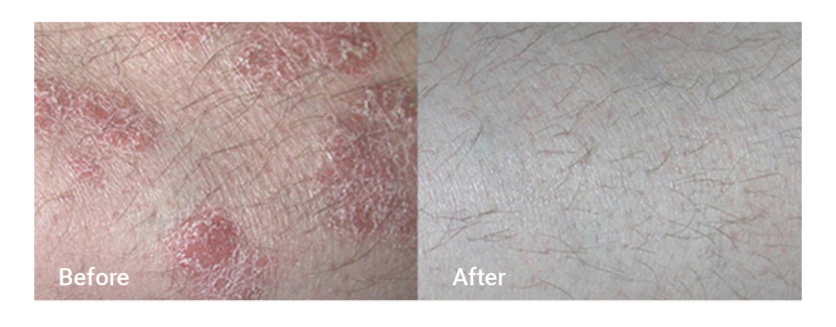 skin with rosacea before and after laser treatment