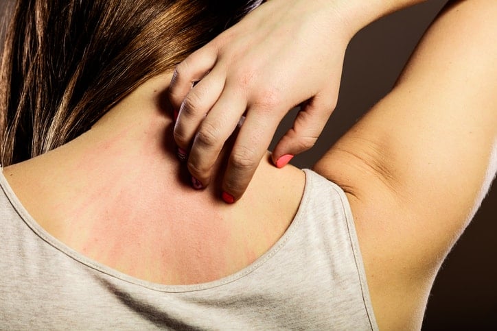 Rashes from Skin Allergies