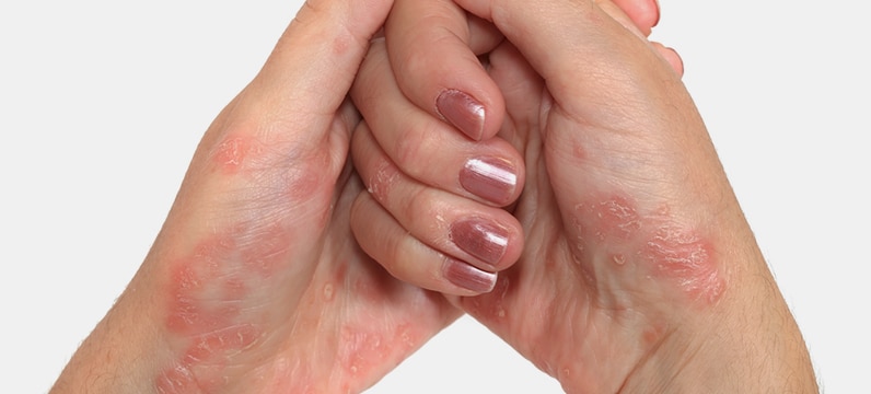 hands showing signs of psoriasis