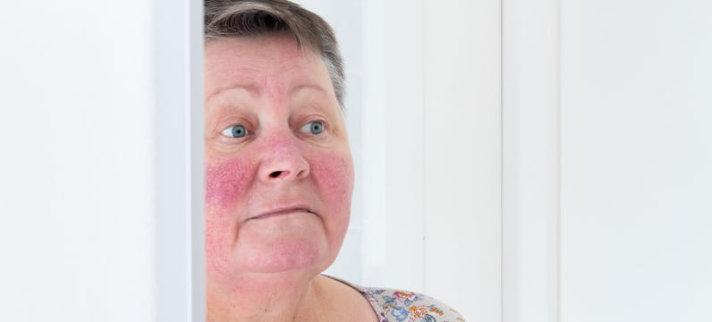 woman with rosacea looking at her face in the mirror