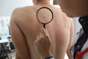 Close-up of female doctor checking male patient using magnifying glass at hospital. Consultation before removal blemish on back. Modern medicine concept