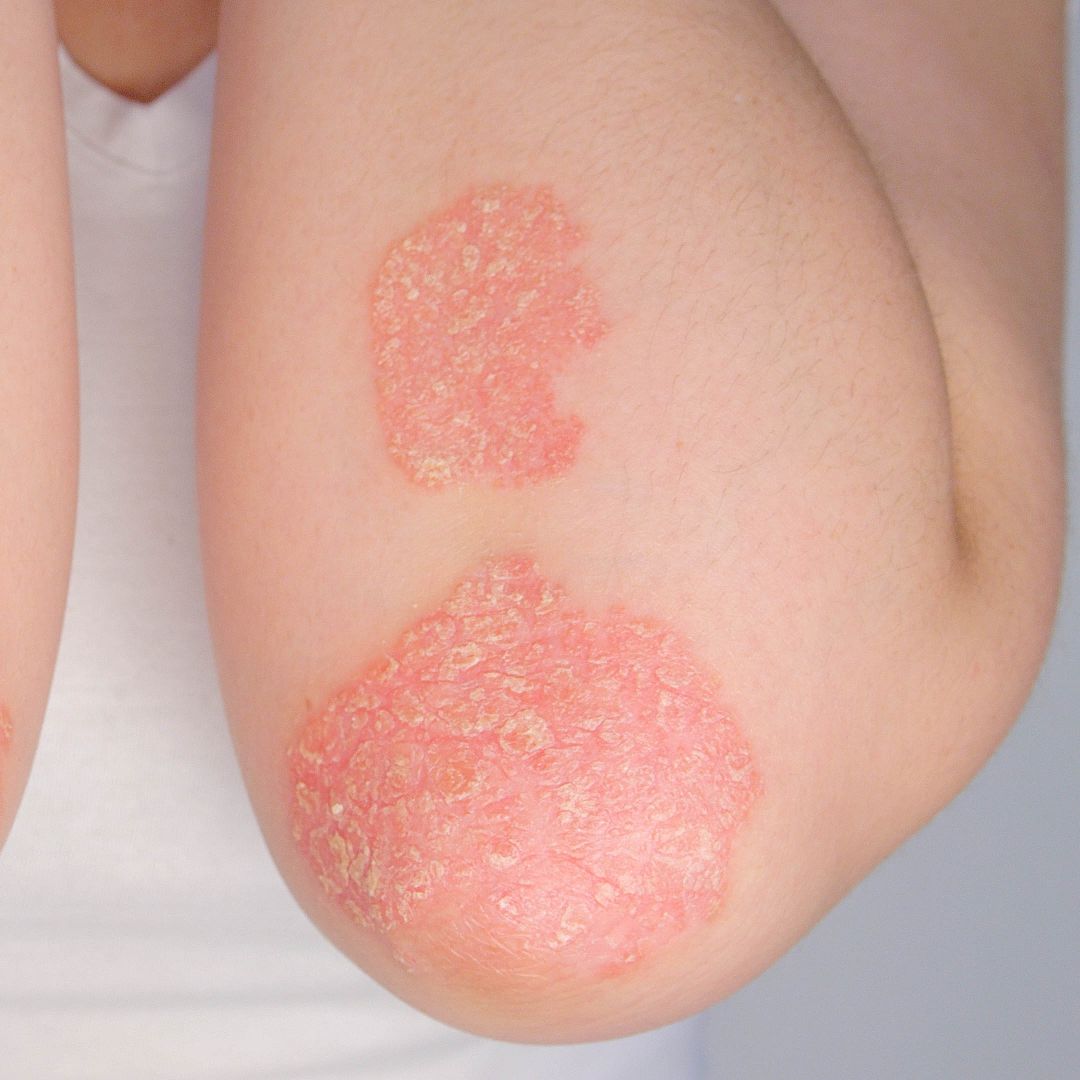 elbow with eczema symptoms - dry, scaly skin