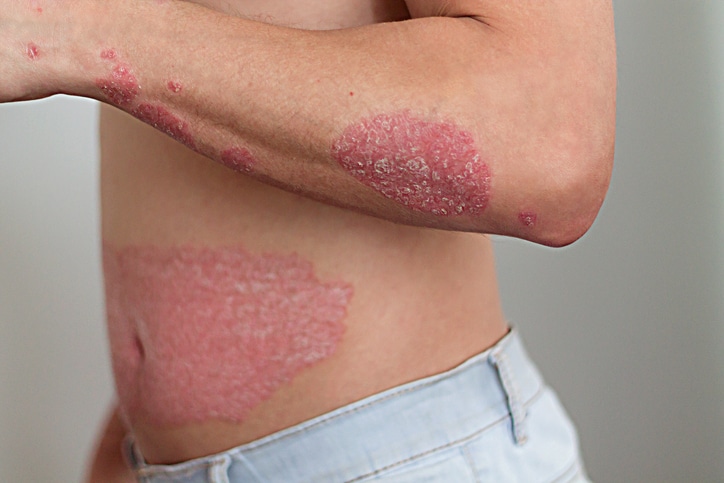 the man with psoriasis on the arm and abdomen