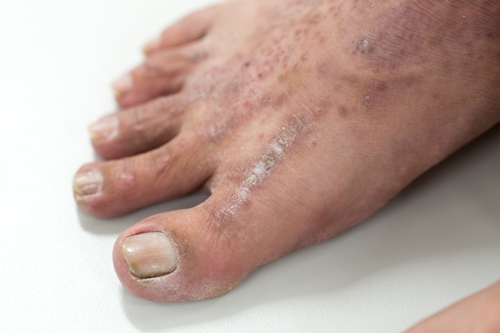psoriasis on a foot