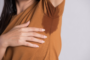  Hyperhidrosis 