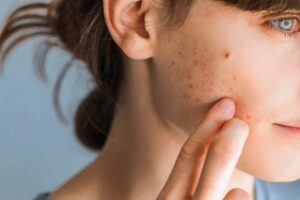 Woman showing acne breakout on cheeks that may require dermatological care