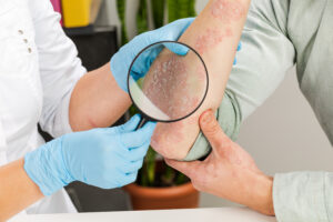 Dermatologist examining psoriasis on a patient's elbow using a magnifying glass