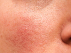 Closeup of rosacea flare-up on a person’s cheek