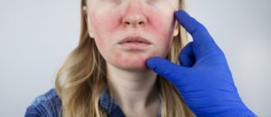 Rosacea Treatment Pinecrest FL