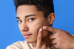 Young man popping pimple on his cheek